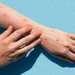 Pakistan confirms first monkeypox case of 2024 - Health